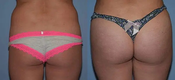 Before and after results of a brazilian butt lift patient