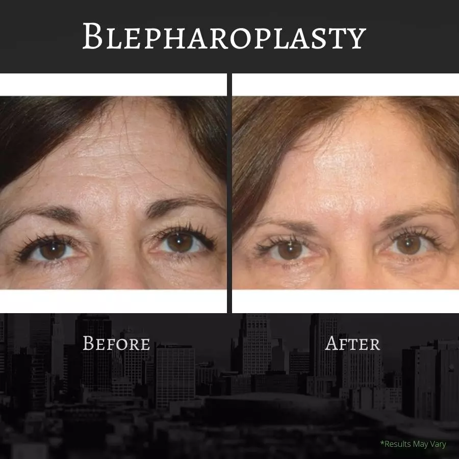 Before and after images of an eyelid lift, or blepharoplasty.