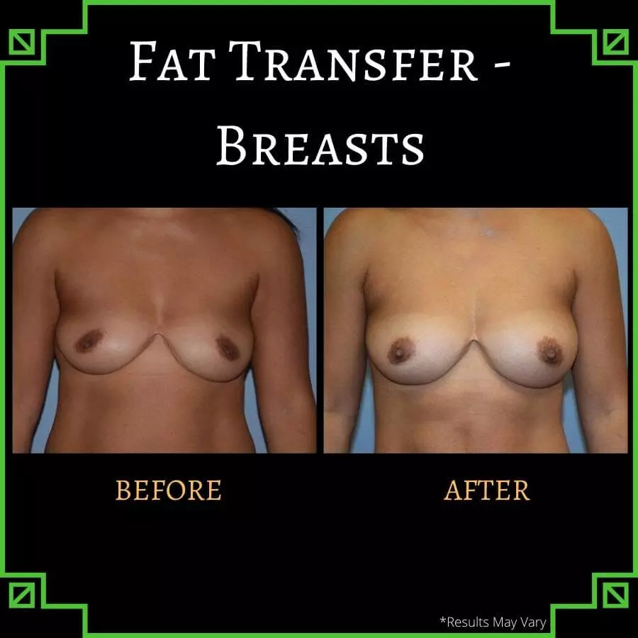 Fat transfer provides results that fit in beautifully with the rest of your body—all without the use of foreign substances or implants, as shown in this before-and-after shot of a young woman who received fat transfer for breast augmentation.