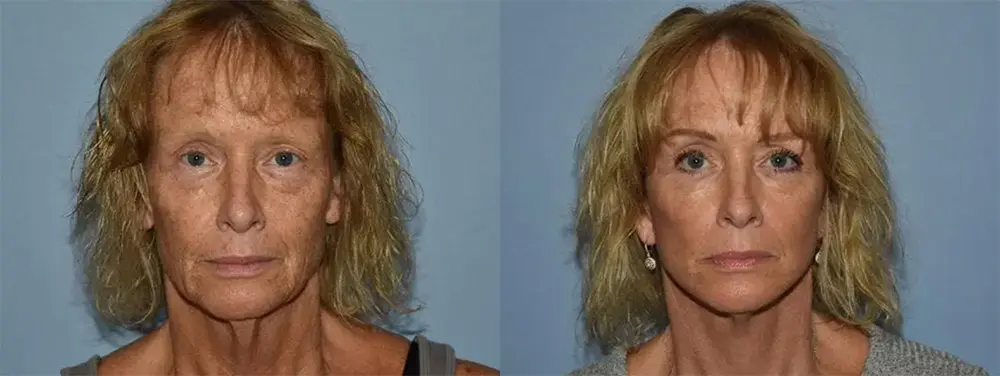 Before After photo