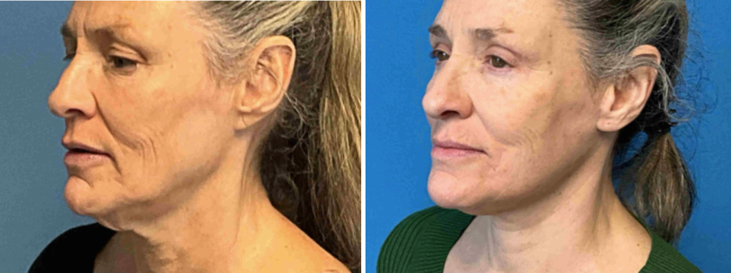 before and after patient 2
