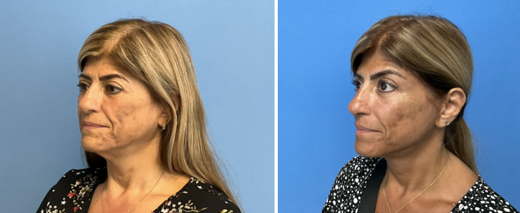 before and after patient 3
