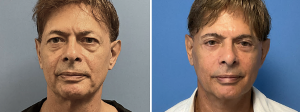 before and after patient 4