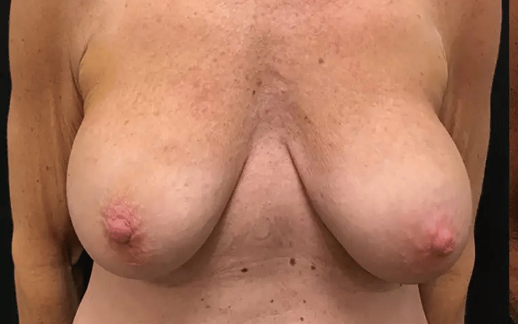BodyTite--Case-Study-1846 | Before BodyTite