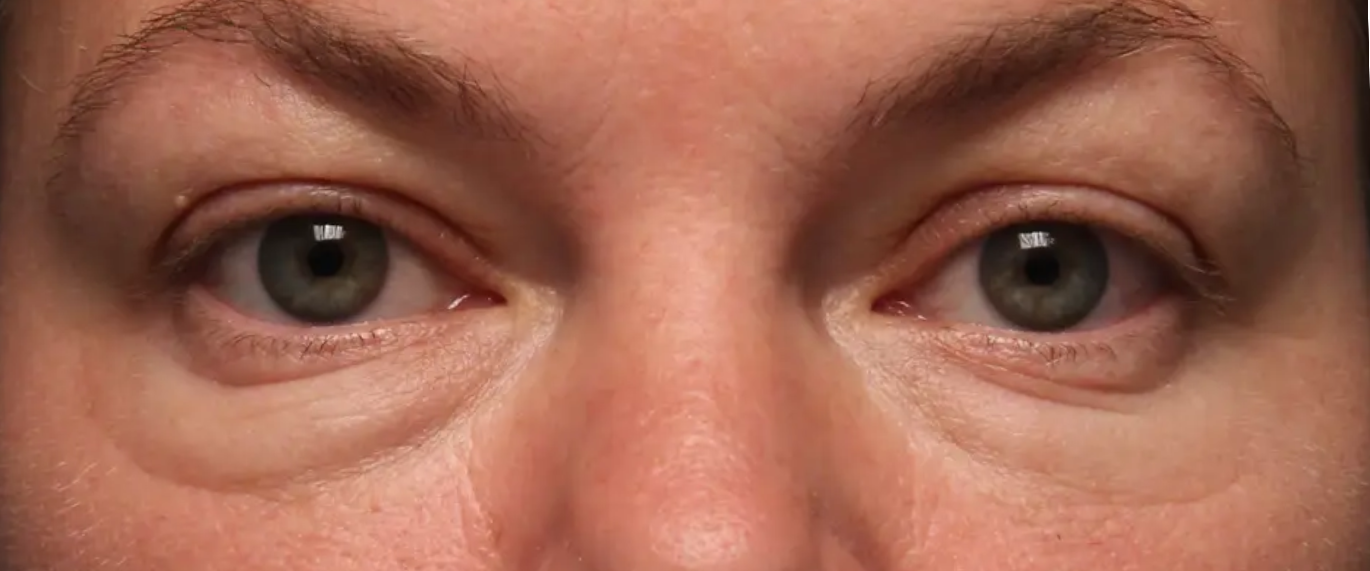 FaceTite--amp--AccuTite--Case-Study-9264 | Before AccuTite