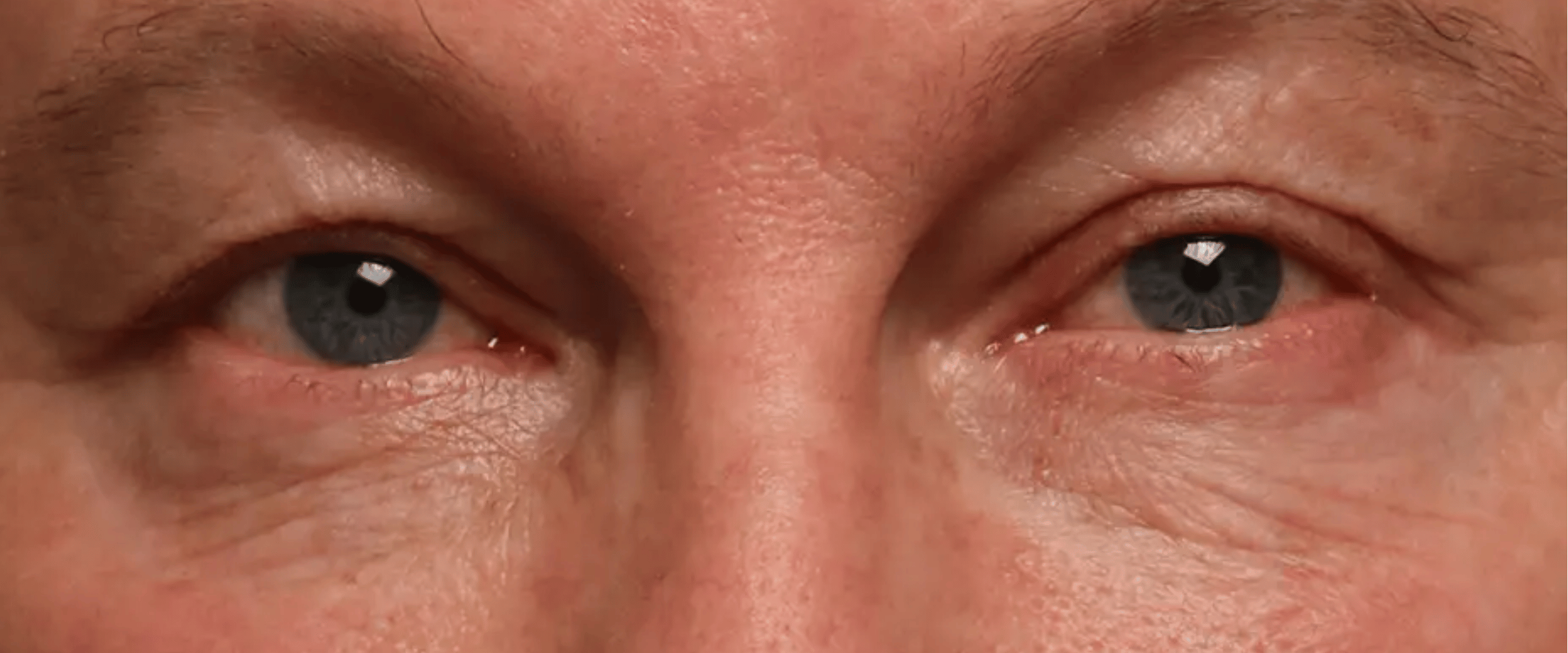 Facetite--amp--Accutite--Case-Study-7482 | After AccuTite