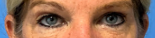 Blepharoplasty-With-Accutite | After AccuTite