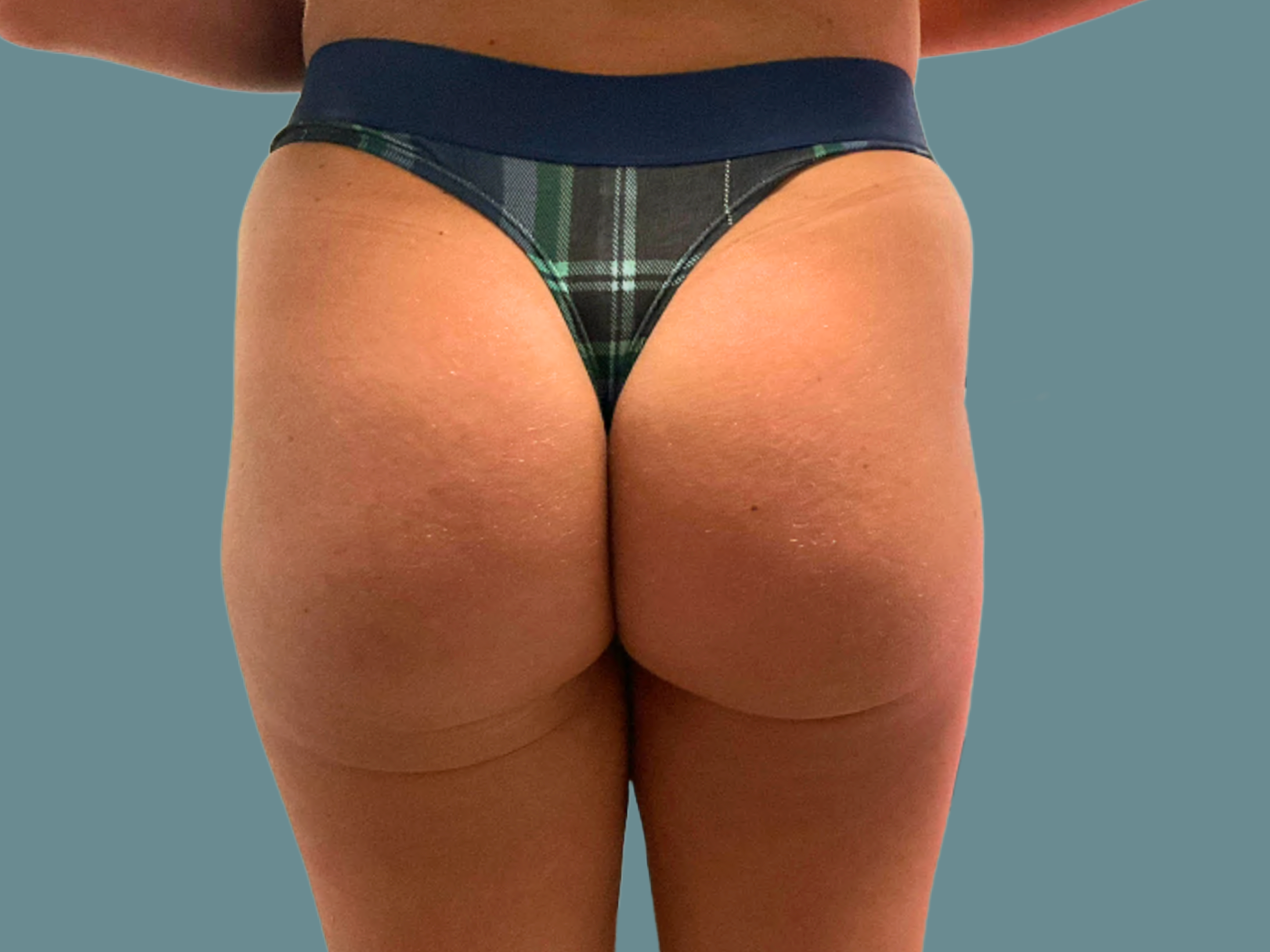 Brazilian-Butt-Lift--case--1328 | After Brazilian Butt Lift