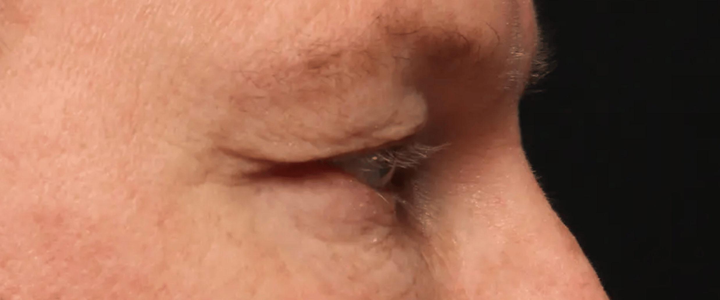 FaceTite--amp--AccuTite--Case-Study-4857 | Before AccuTite