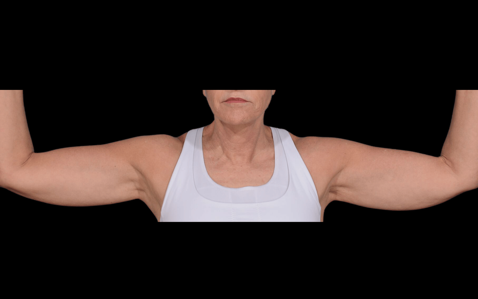 BodyTite--Case-Study-2819 | Before BodyTite