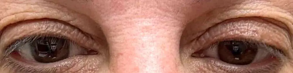 Facelift-Case--2918 | Before Blepharoplasty