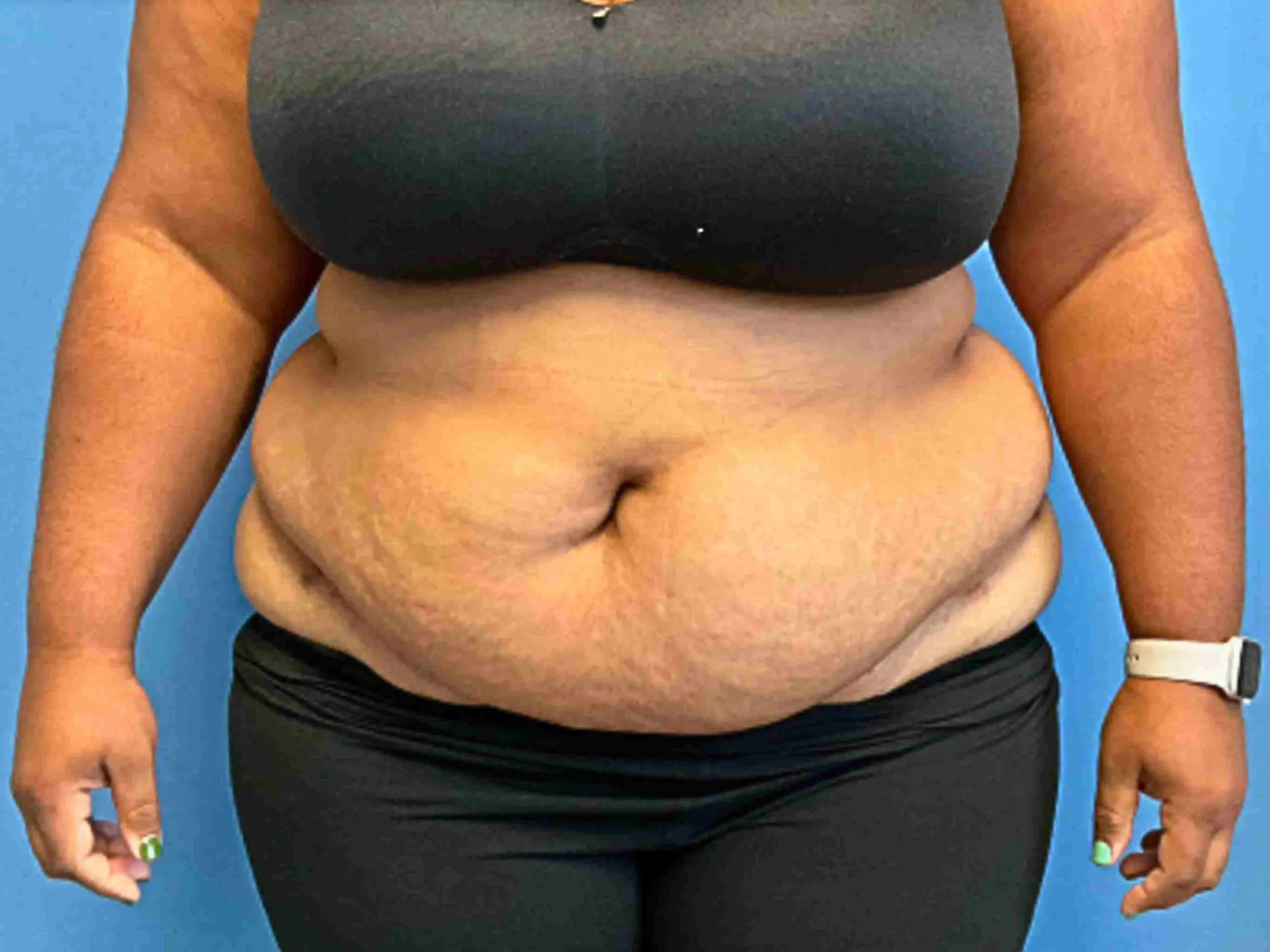 tummy-tuck-Case-6314 | Before Liposuction