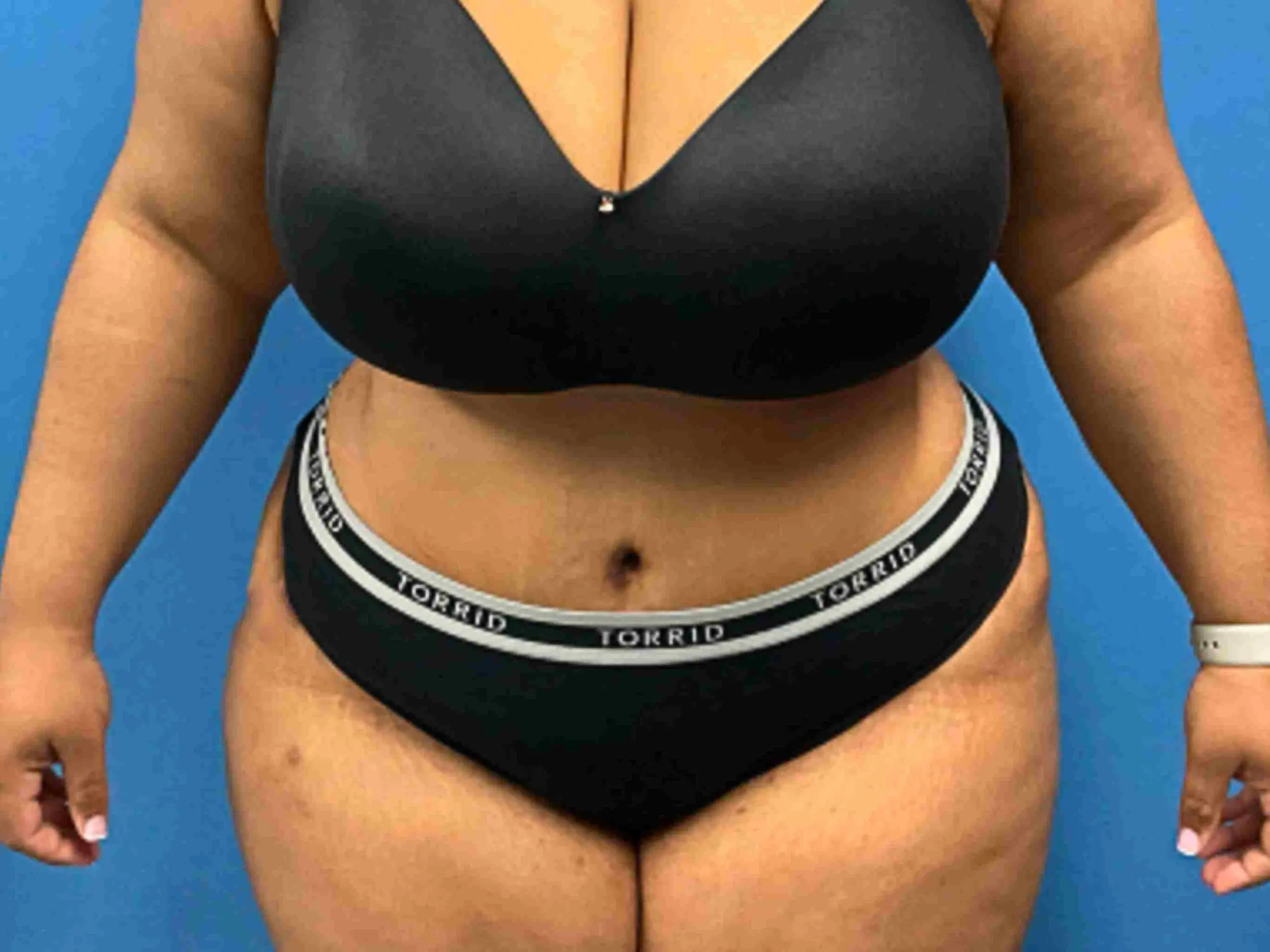 tummy-tuck-Case-6314 | After Liposuction