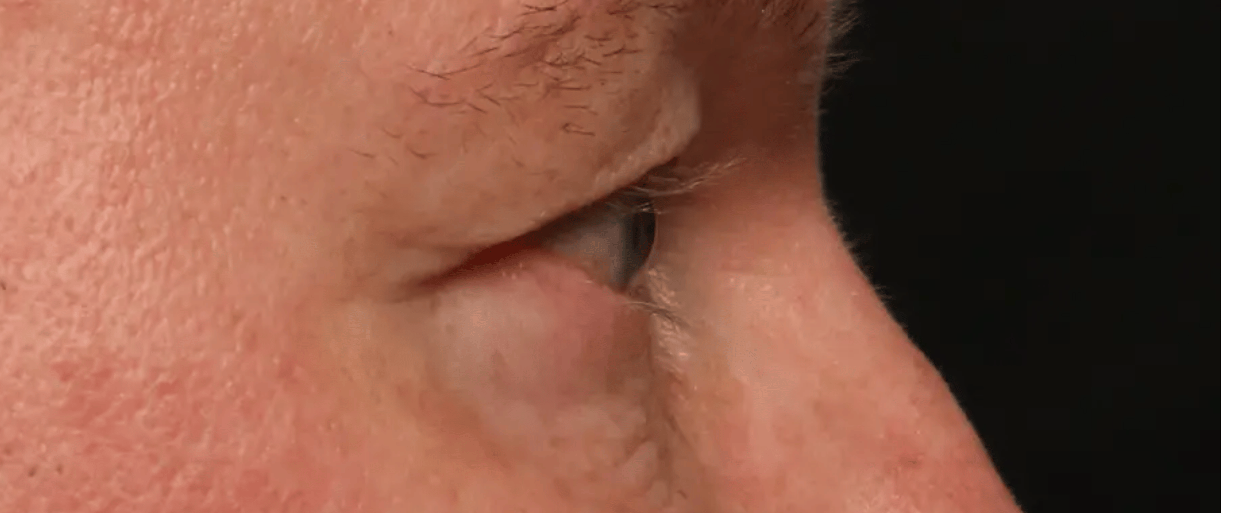 FaceTite--amp--AccuTite--Case-Study-4857 | After AccuTite