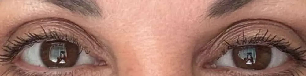 Facelift-Case--2918 | After Blepharoplasty