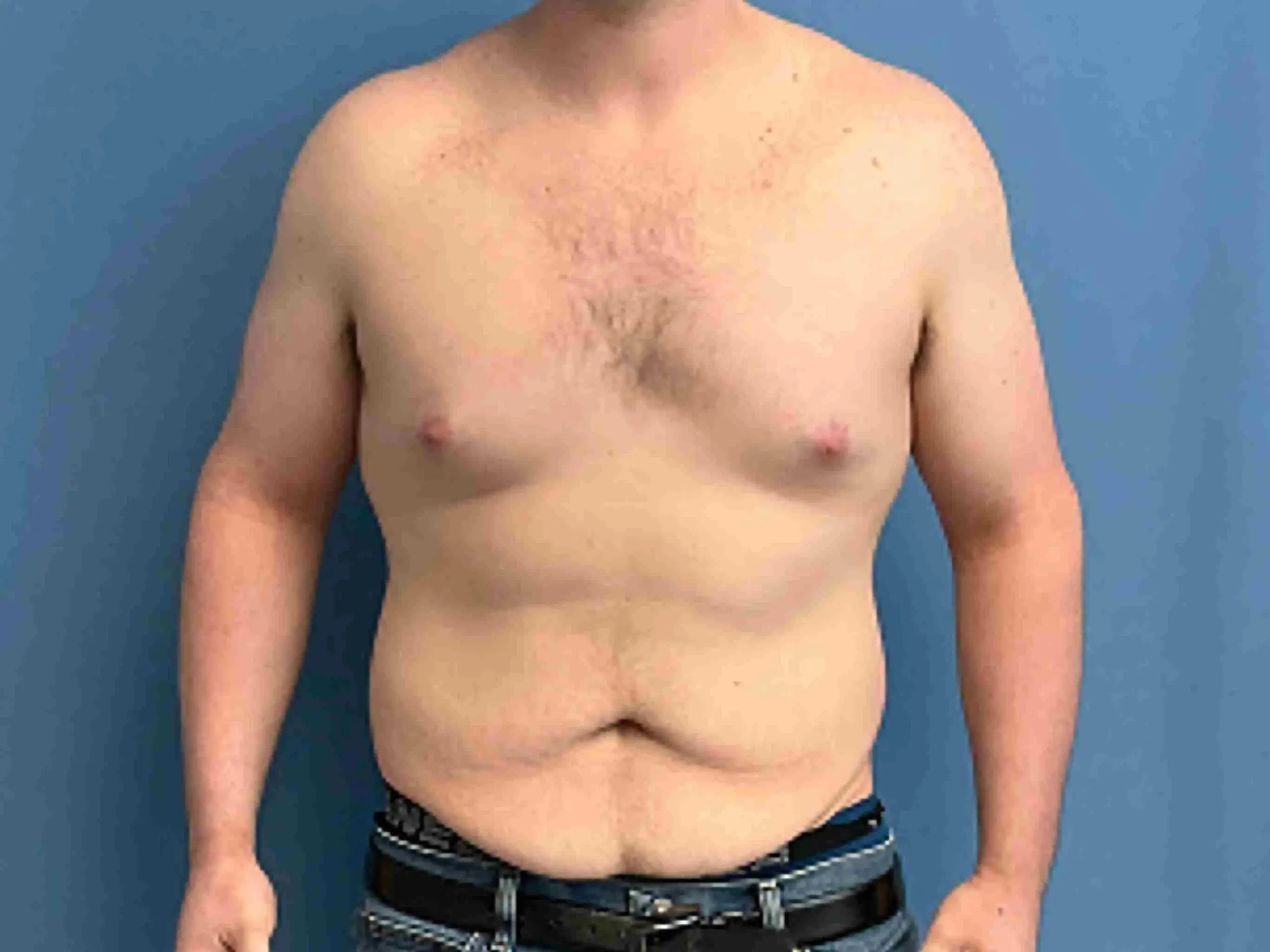 Panniculectomy-case--2876 | Before Liposuction