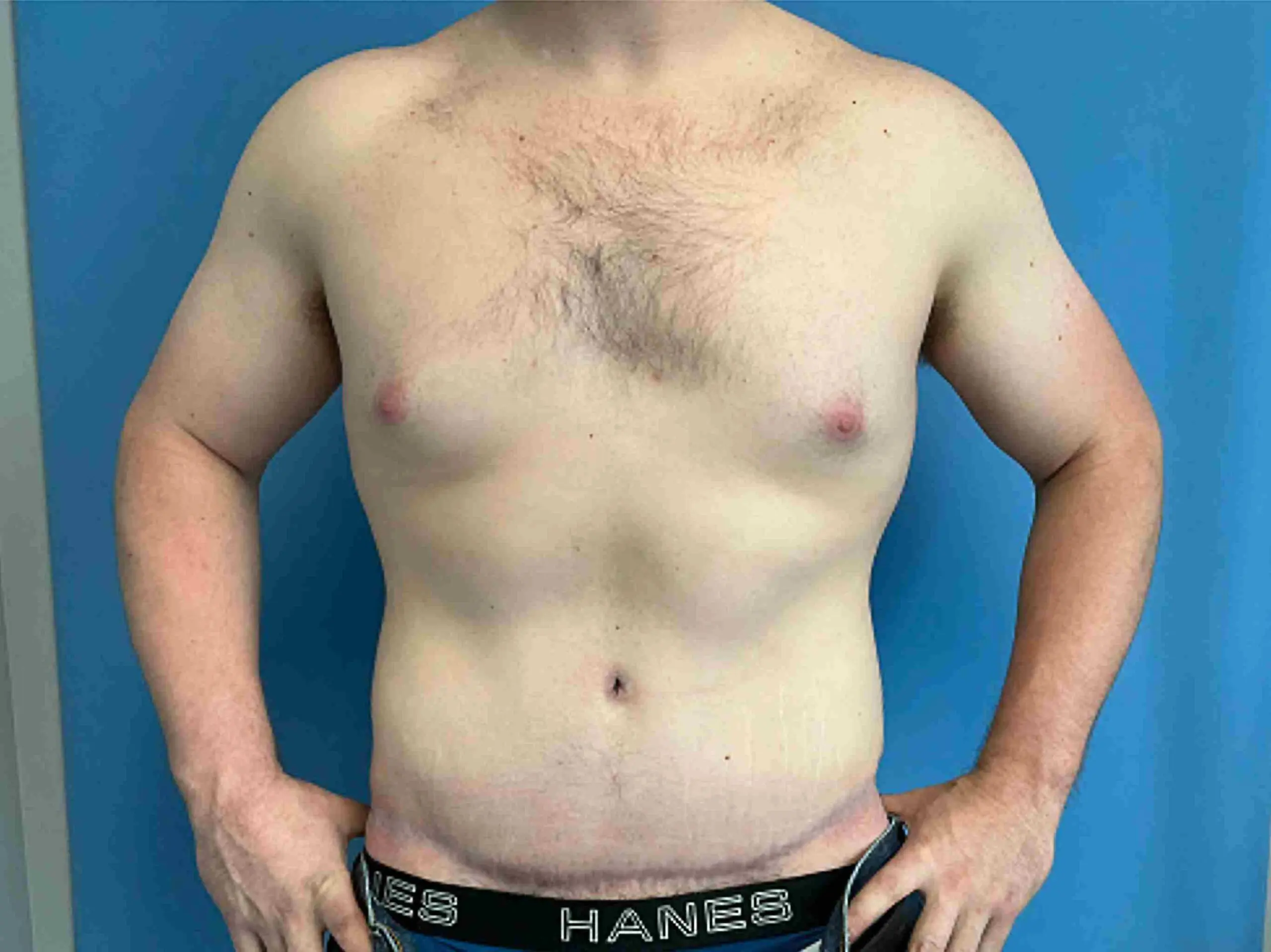 Panniculectomy-case--2876 | After Liposuction