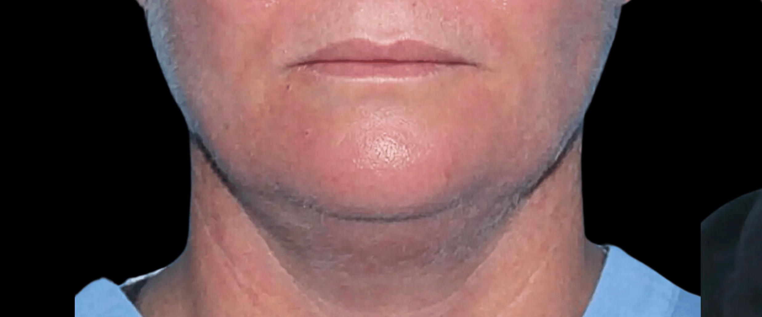FaceTite--Case-Study-8263 | Before FaceTite
