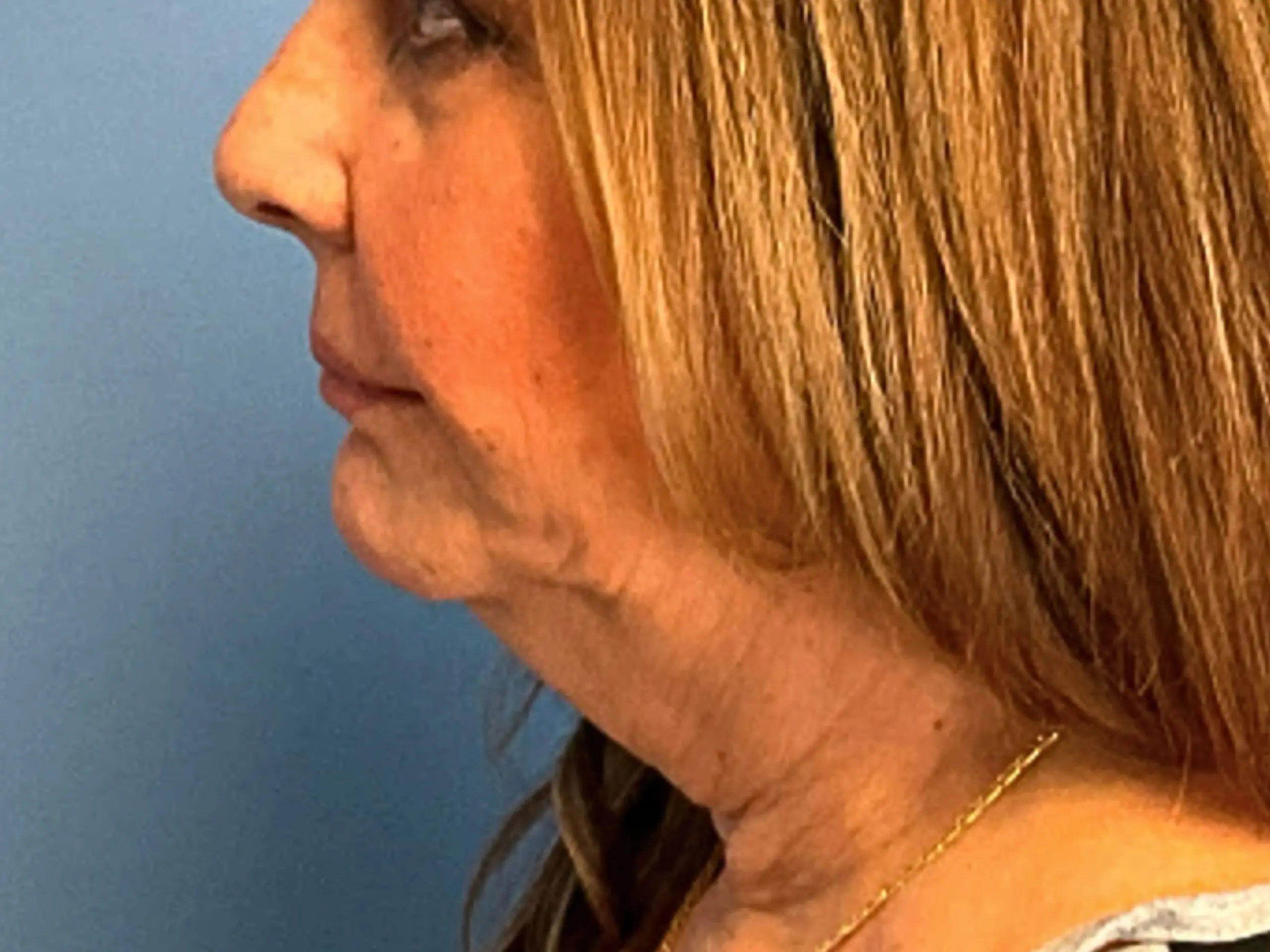 facelift-case--3333 | Before Facelift