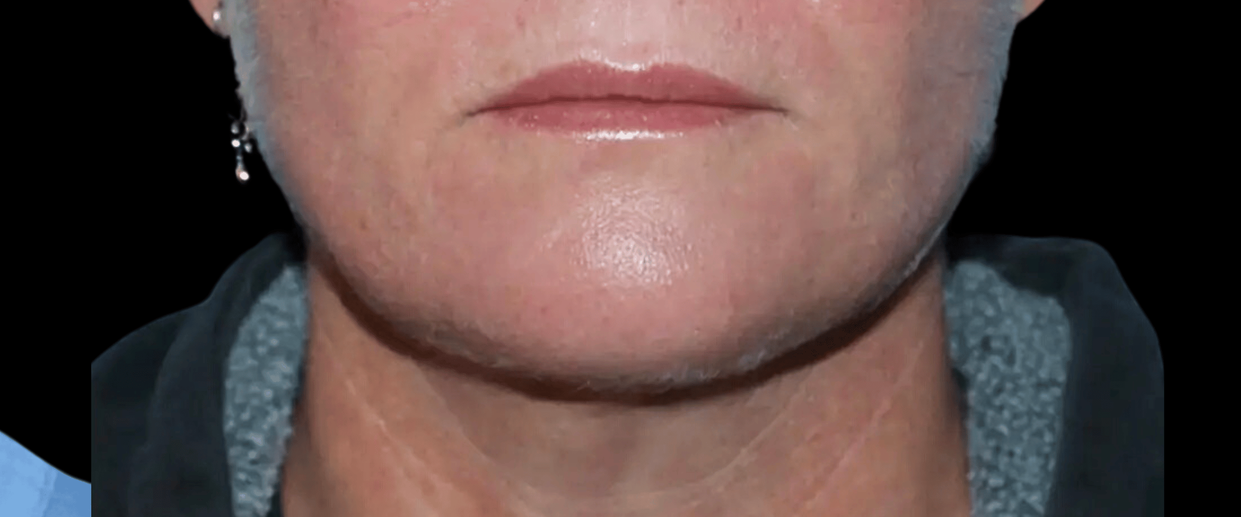 FaceTite--Case-Study-8263 | After FaceTite