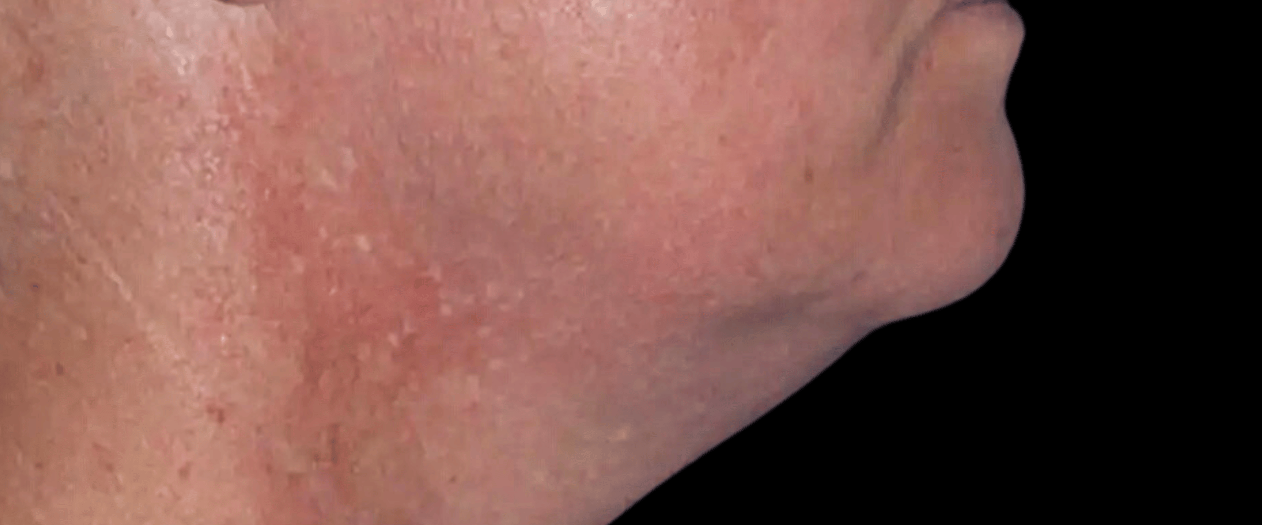 FaceTite--Case-Study-3925 | Before FaceTite