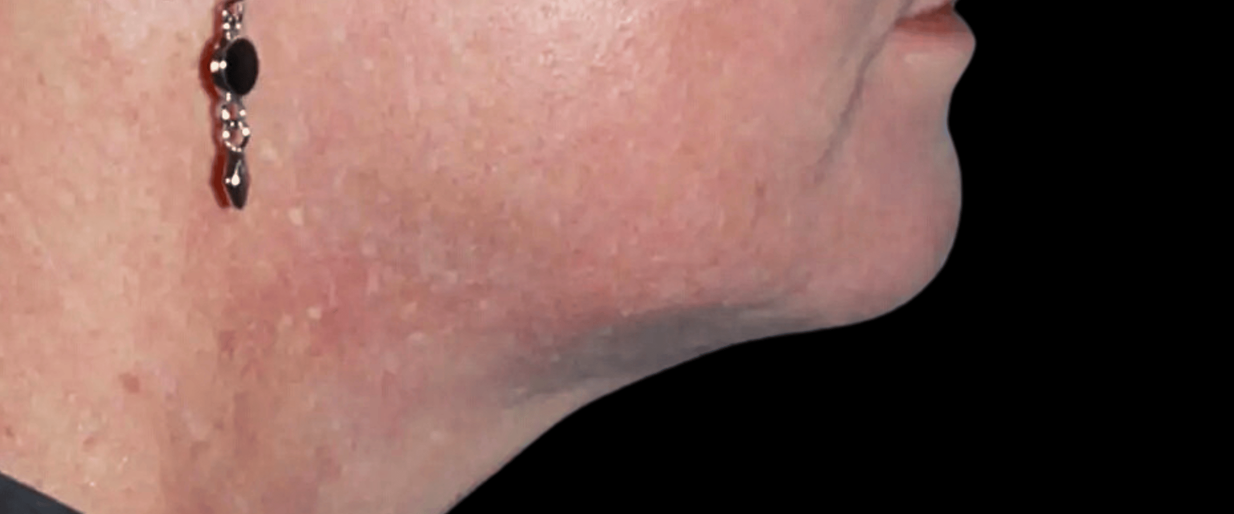 FaceTite--Case-Study-3925 | After FaceTite