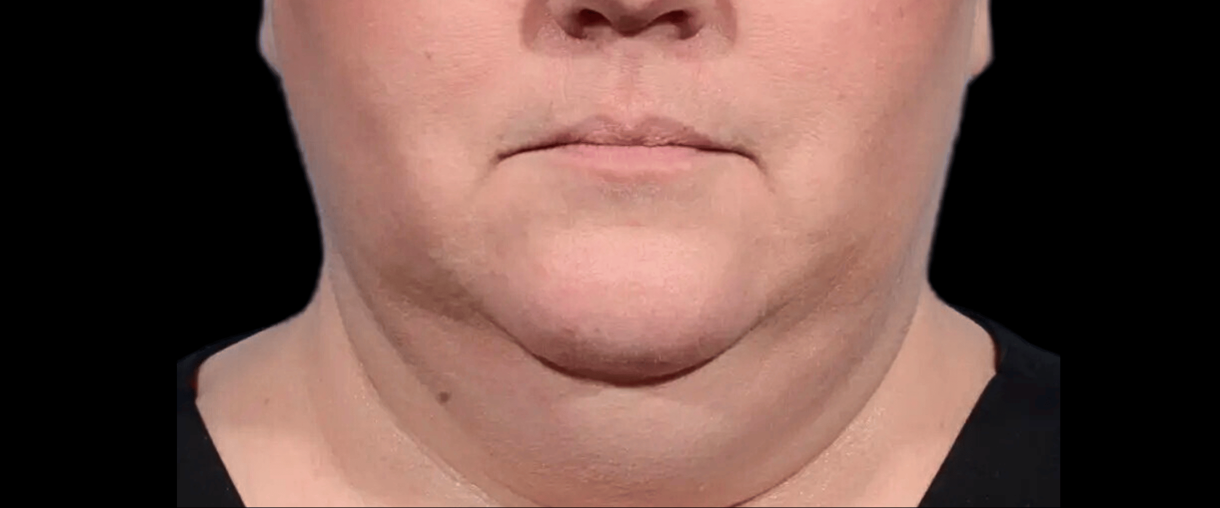FaceTite--Case-Study-7408 | Before FaceTite