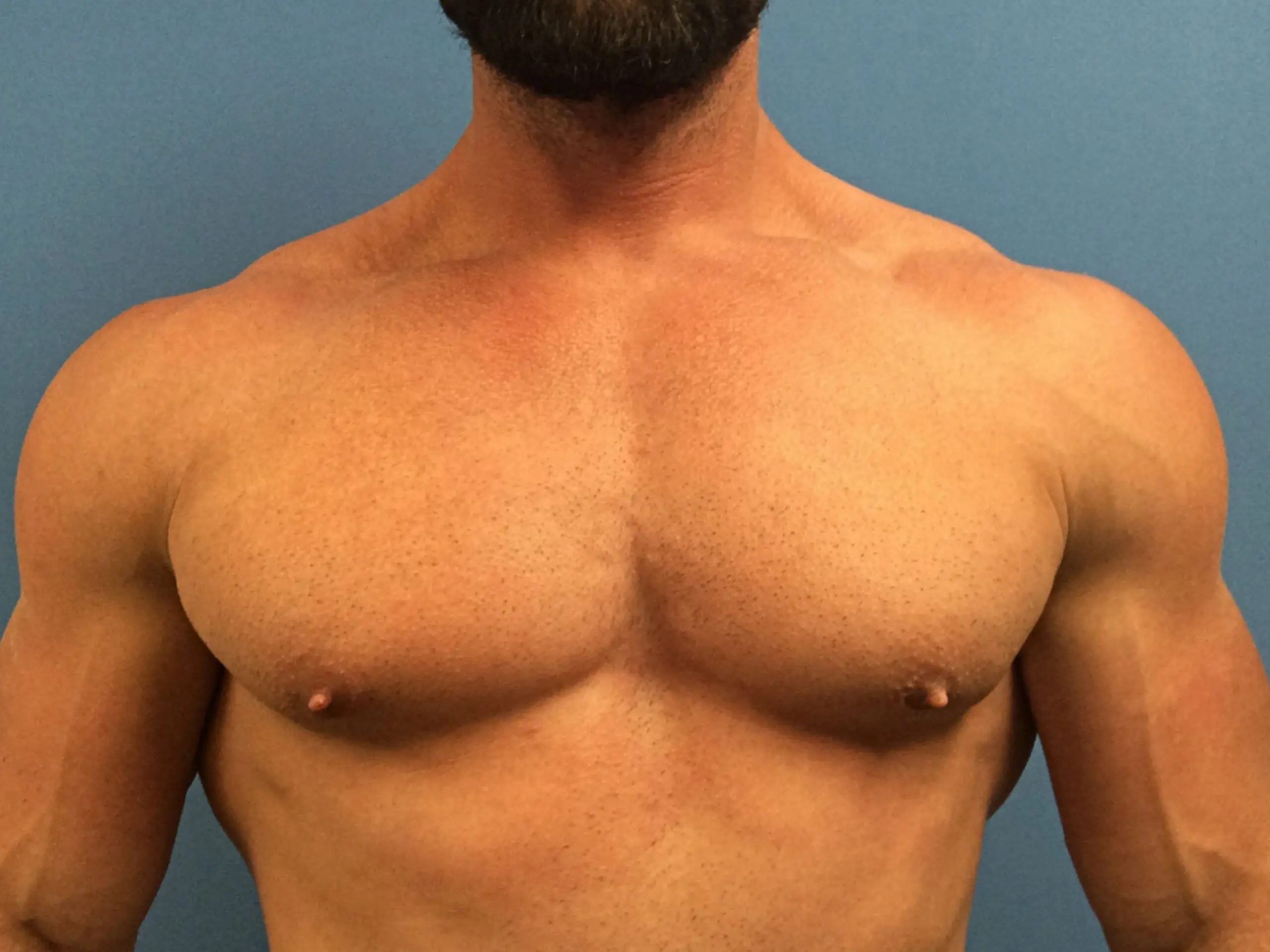 gynecomastia-patient--4856 | After Gynecomastia
