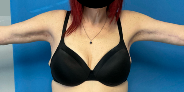 arm-lift--case--2345 | After Body