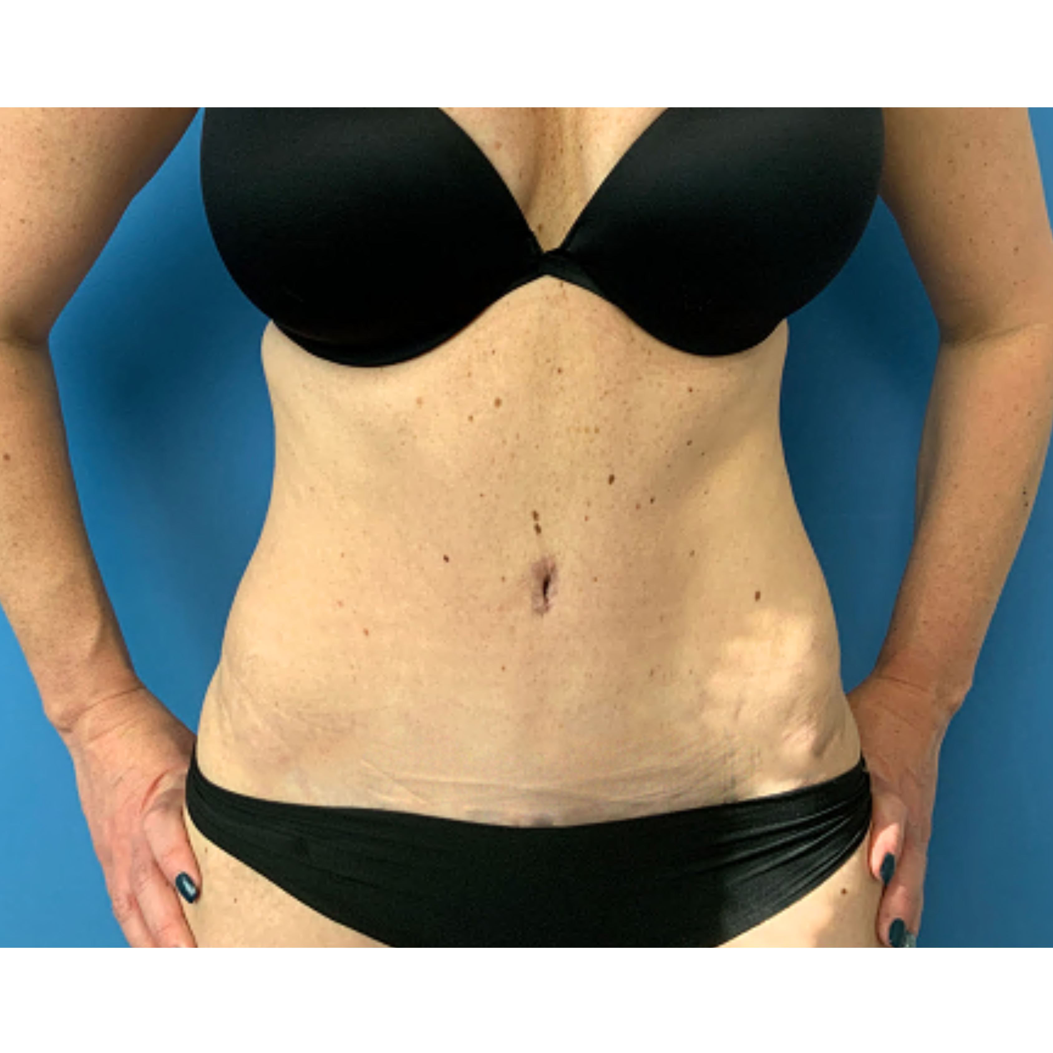 Tummy-Tuck-with-Liposuction--Case-Study-4989 | After Liposuction