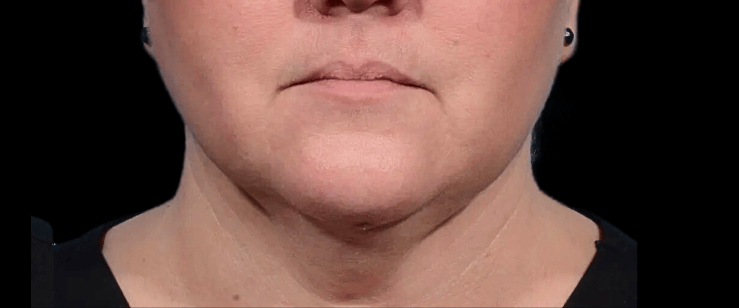 FaceTite--Case-Study-7408 | After FaceTite