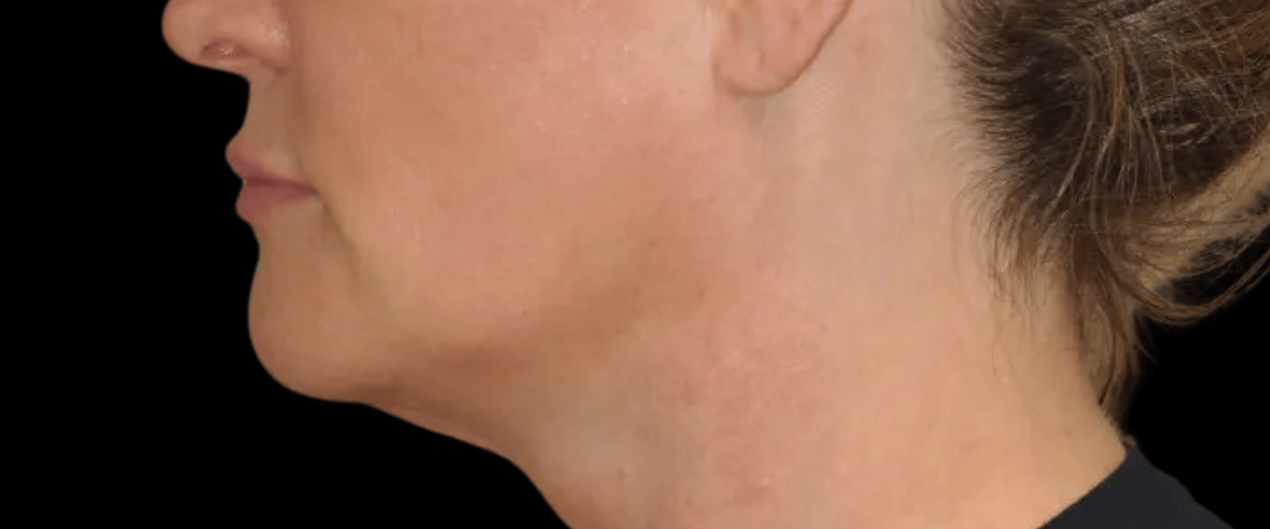 FaceTite--Case-Study-1852 | Before FaceTite