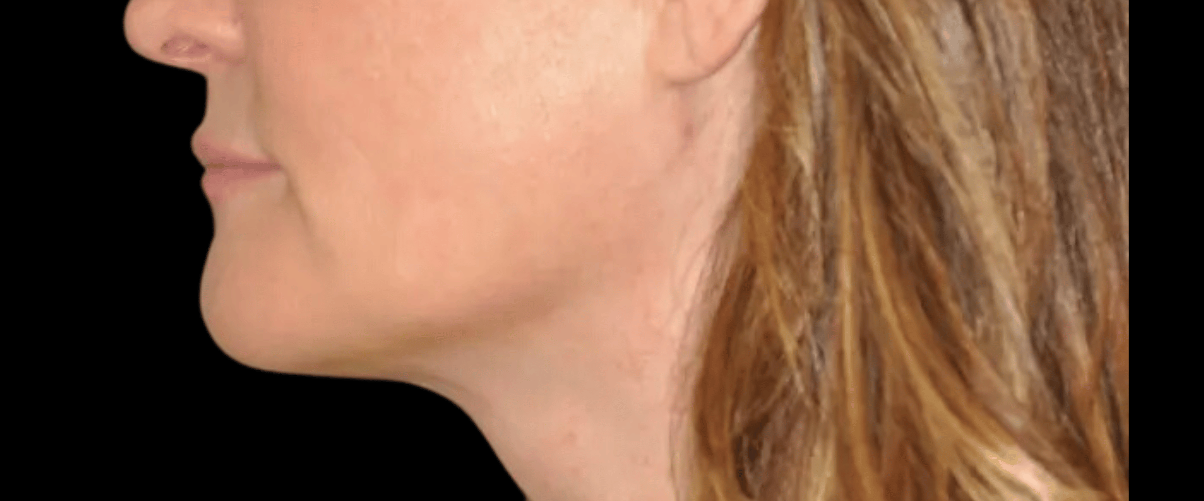 FaceTite--Case-Study-1852 | After FaceTite