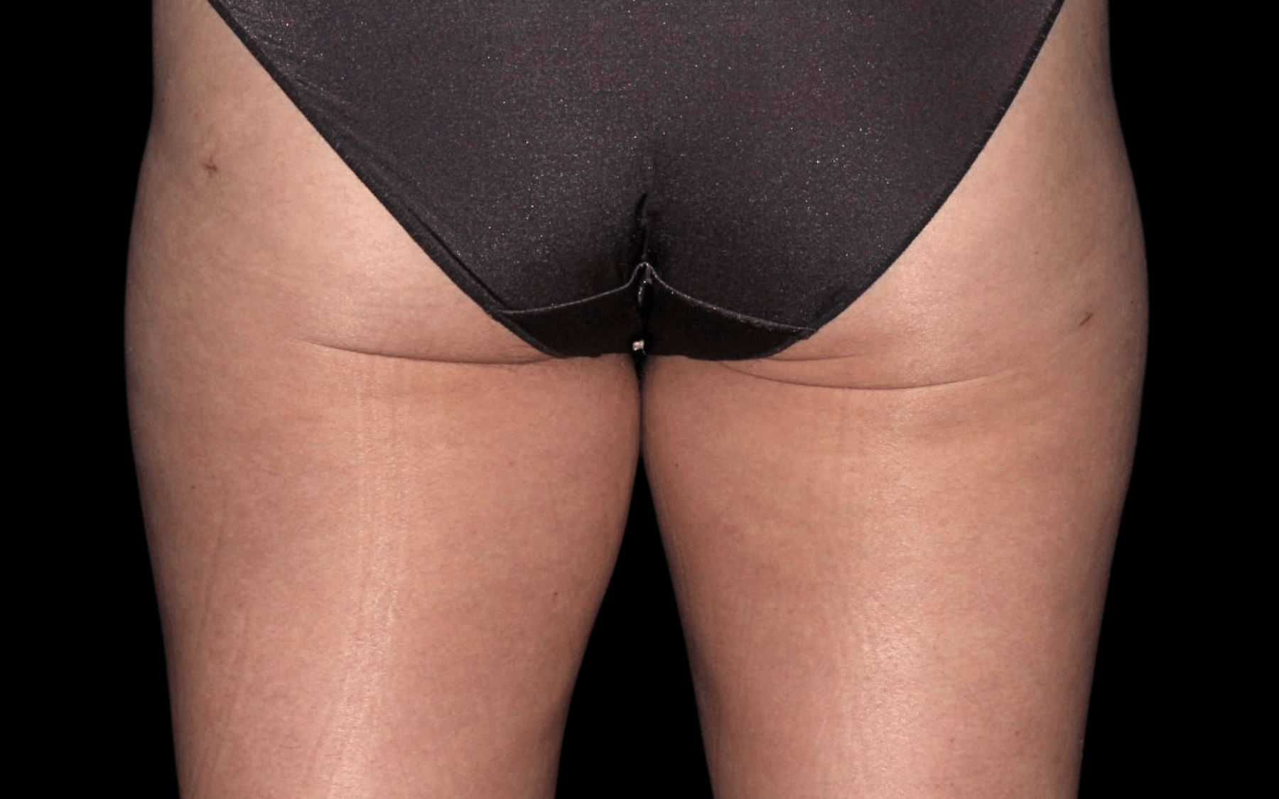 BodyTite--Case-Study-7154 | After BodyTite