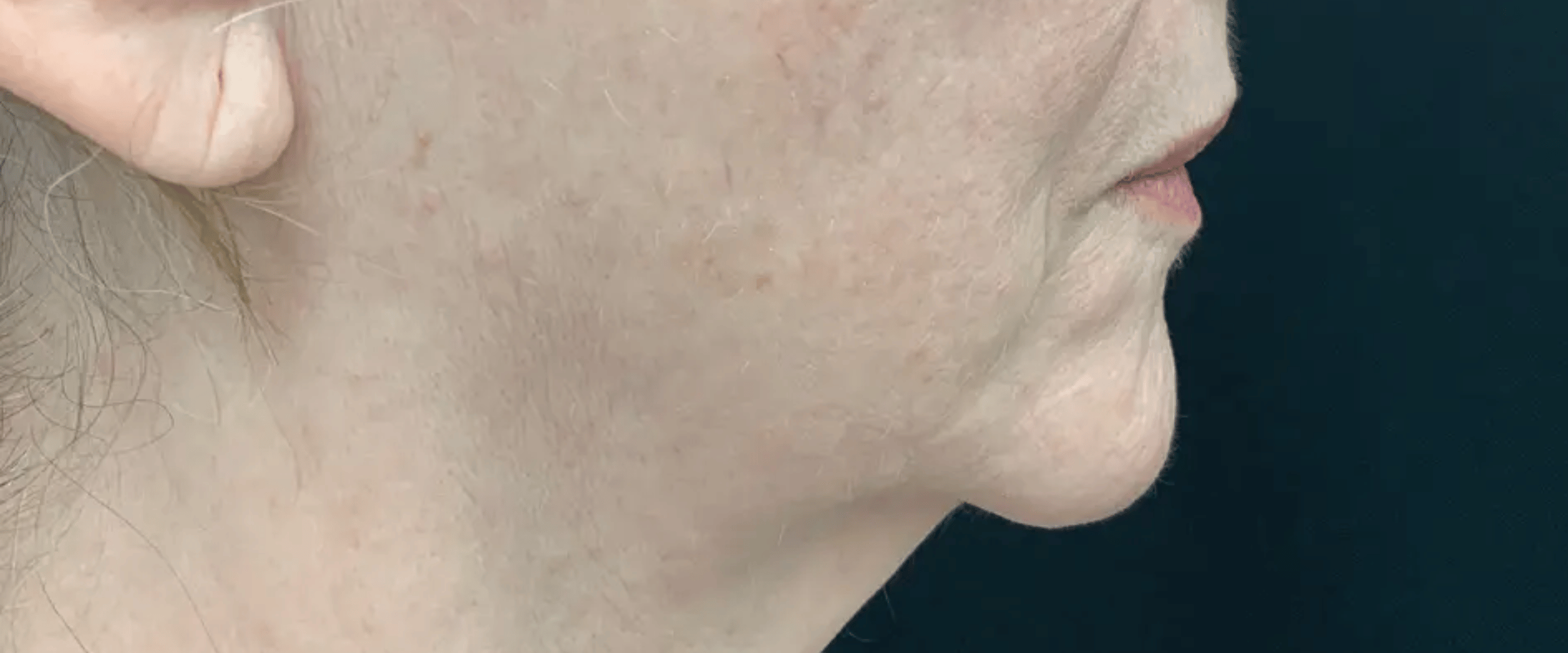 FaceTite--Case-Study-6297 | Before FaceTite