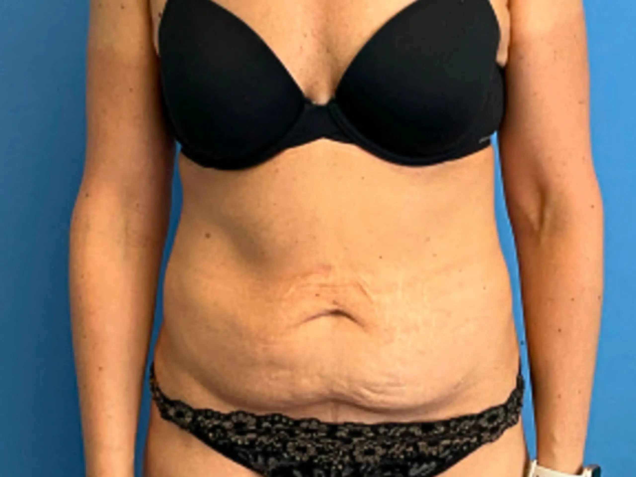 Tummy-Tuck-w--Lipo-Case--3333 | Before Liposuction