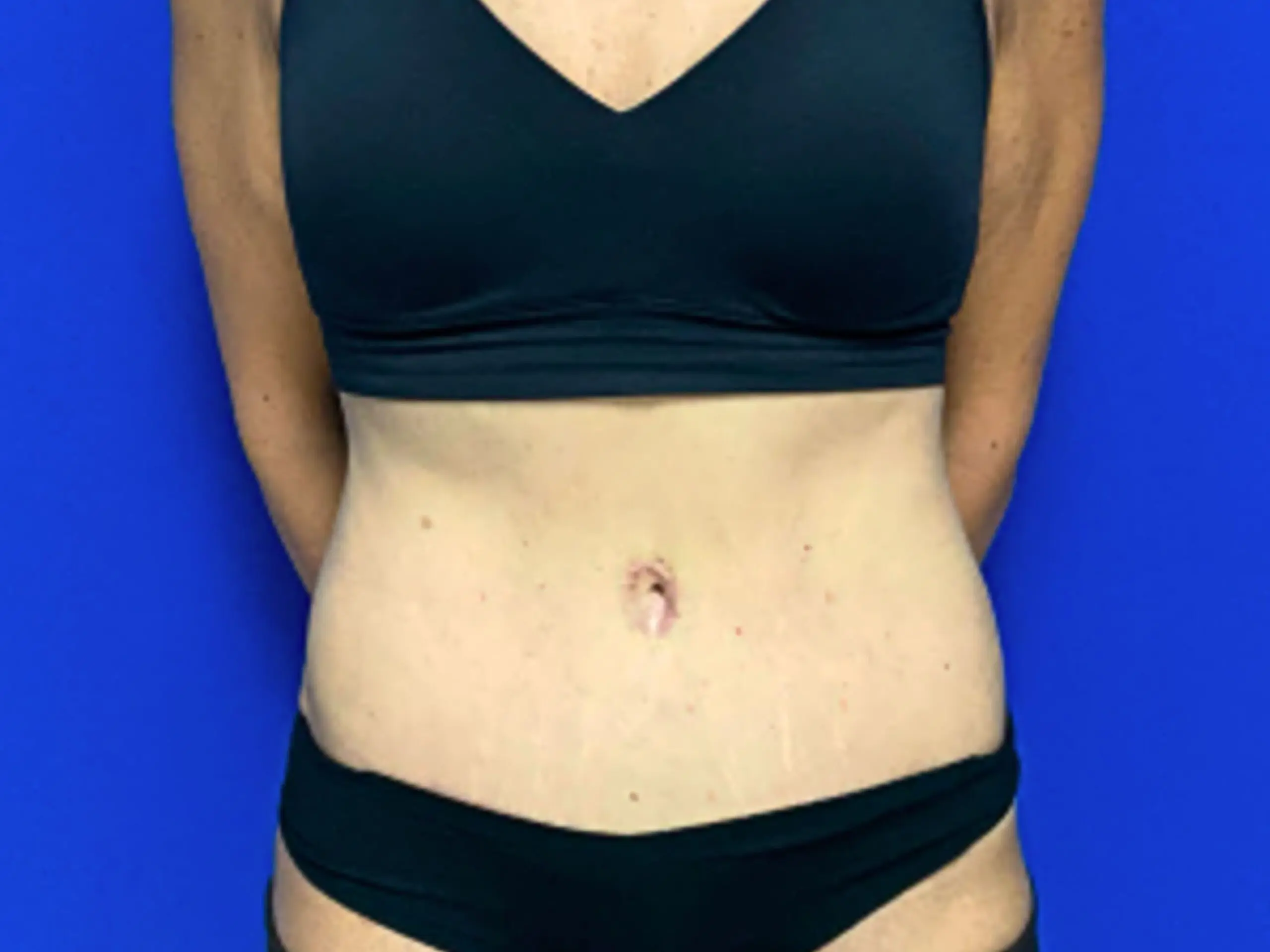 Tummy-Tuck-w--Lipo-Case--3333 | After Liposuction
