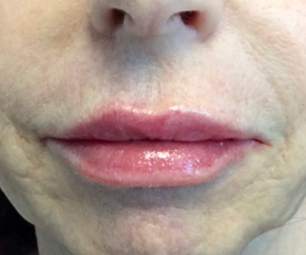 Lip-Filler--Case-Study-6872 | After Non-surgical