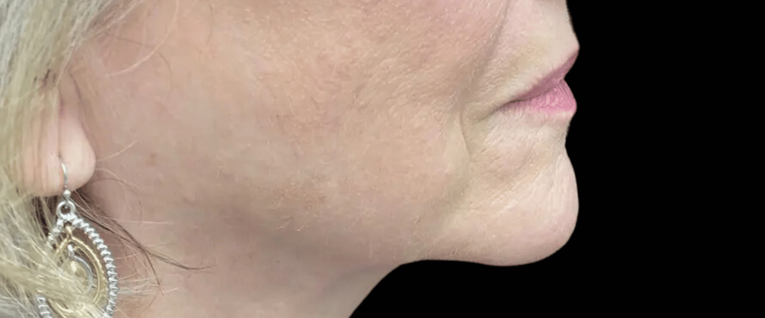 FaceTite--Case-Study-6297 | After FaceTite
