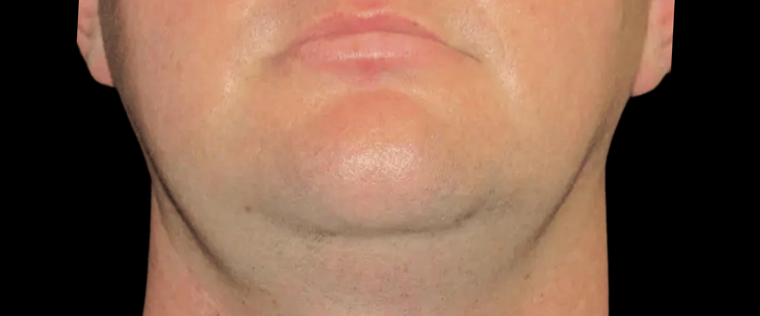 FaceTite--Case-Study-3184 | Before FaceTite