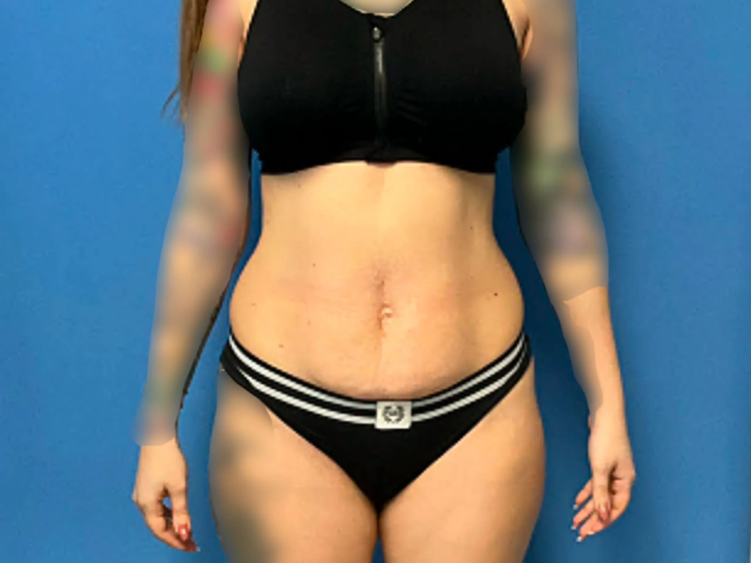 tummy-tuck-w--liposuction-case--4344 | Before Liposuction