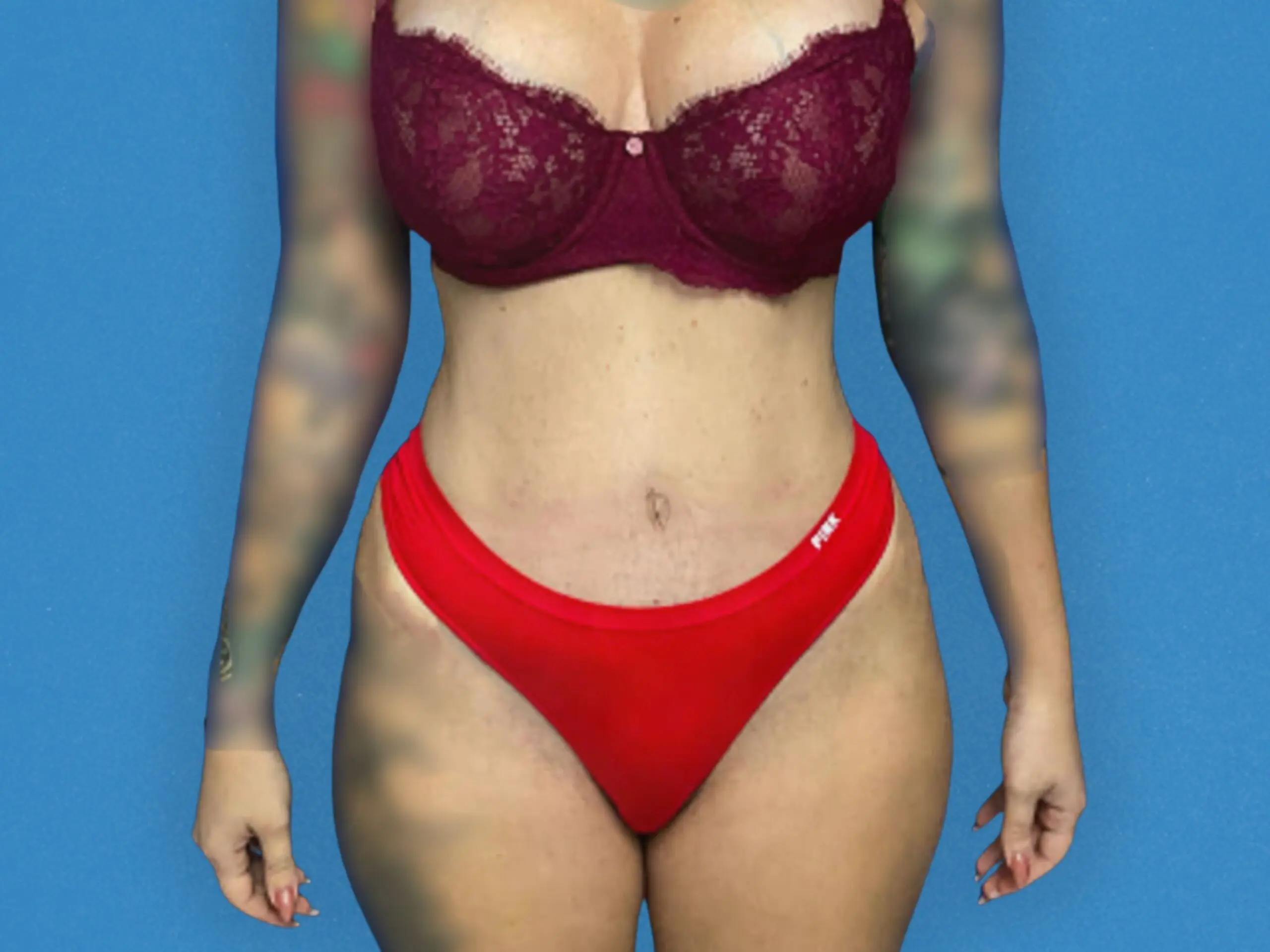 tummy-tuck-w--liposuction-case--4344 | After Liposuction