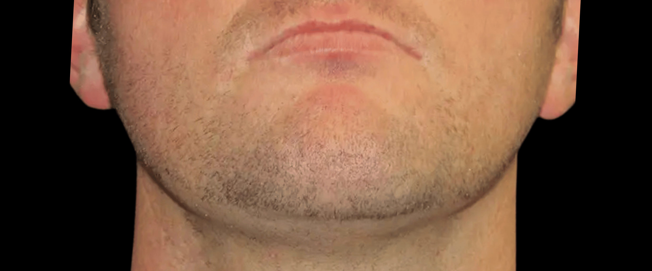 FaceTite--Case-Study-3184 | After FaceTite