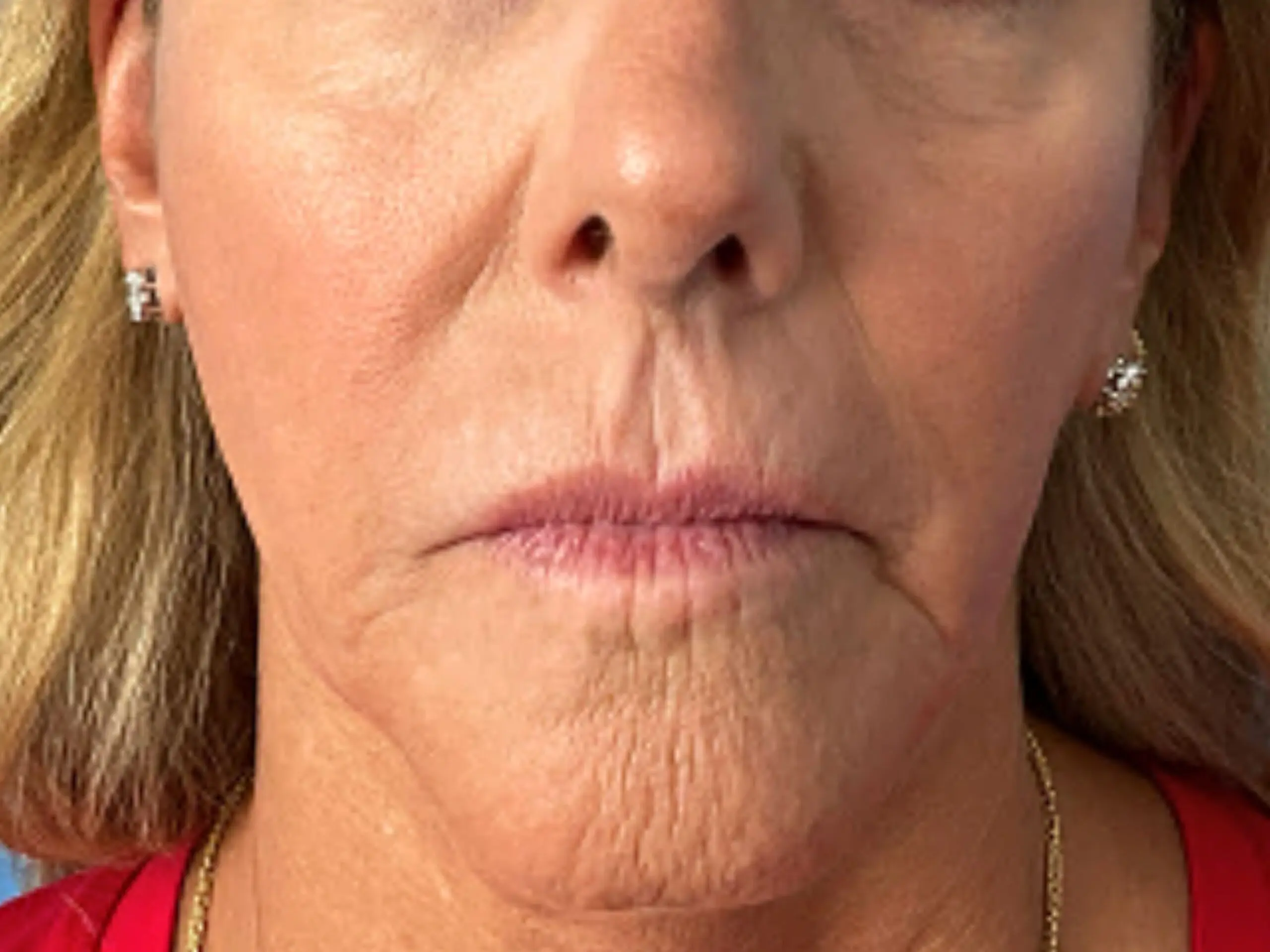 filler-treatment-with-juvederm | Before Non-surgical