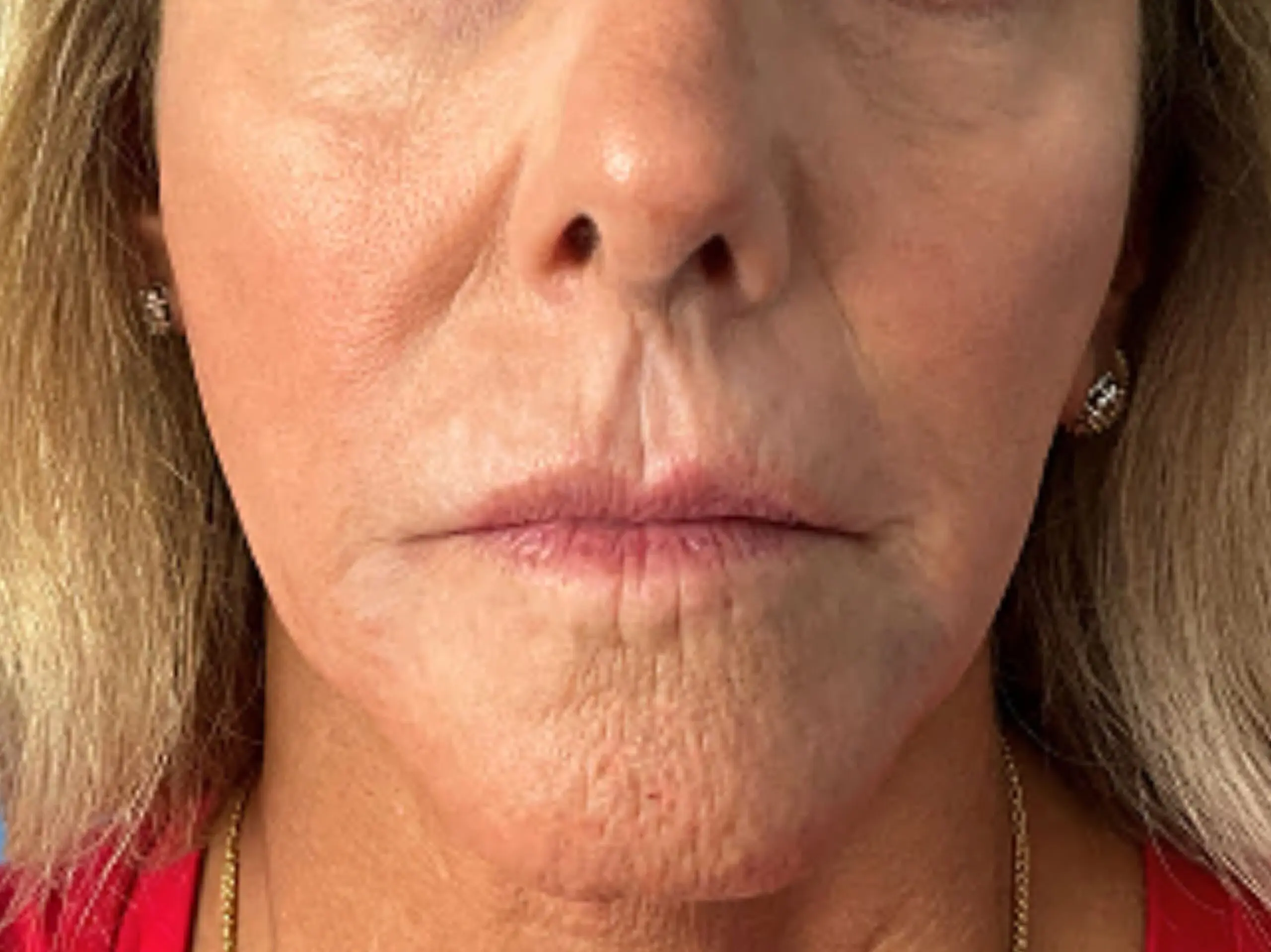 filler-treatment-with-juvederm | After Non-surgical