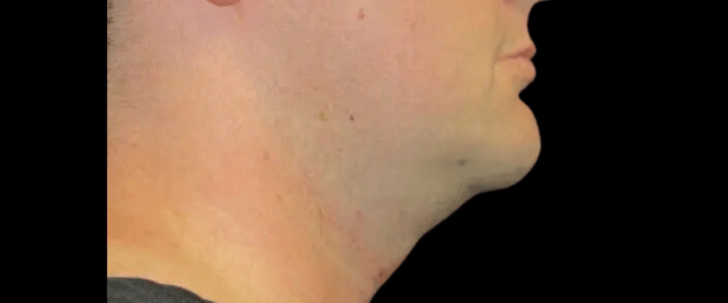 Facetite--Case-Study-7502 | Before FaceTite