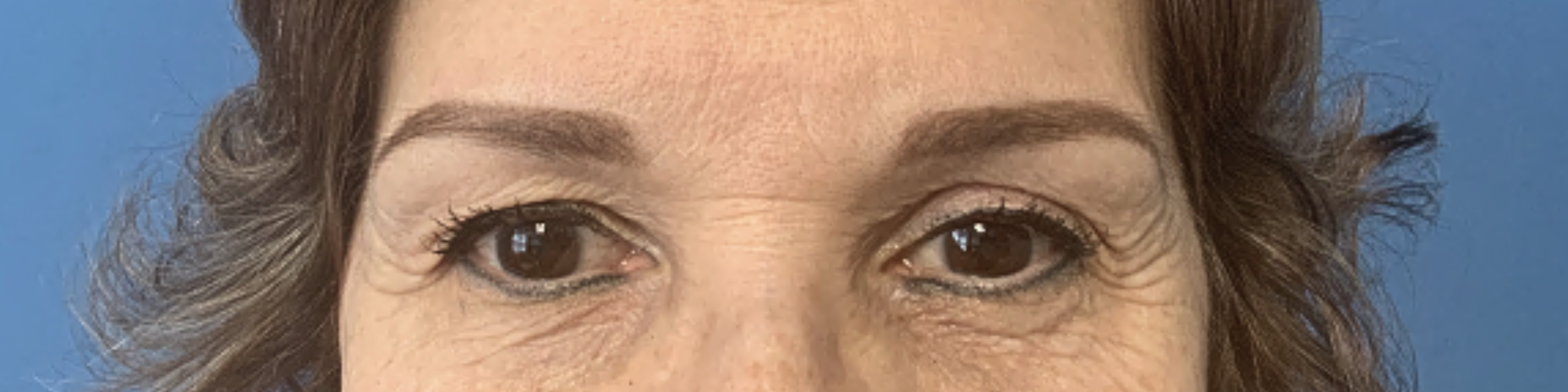 Upper-Blepharoplasty--Case-Study-4299 | Before Blepharoplasty
