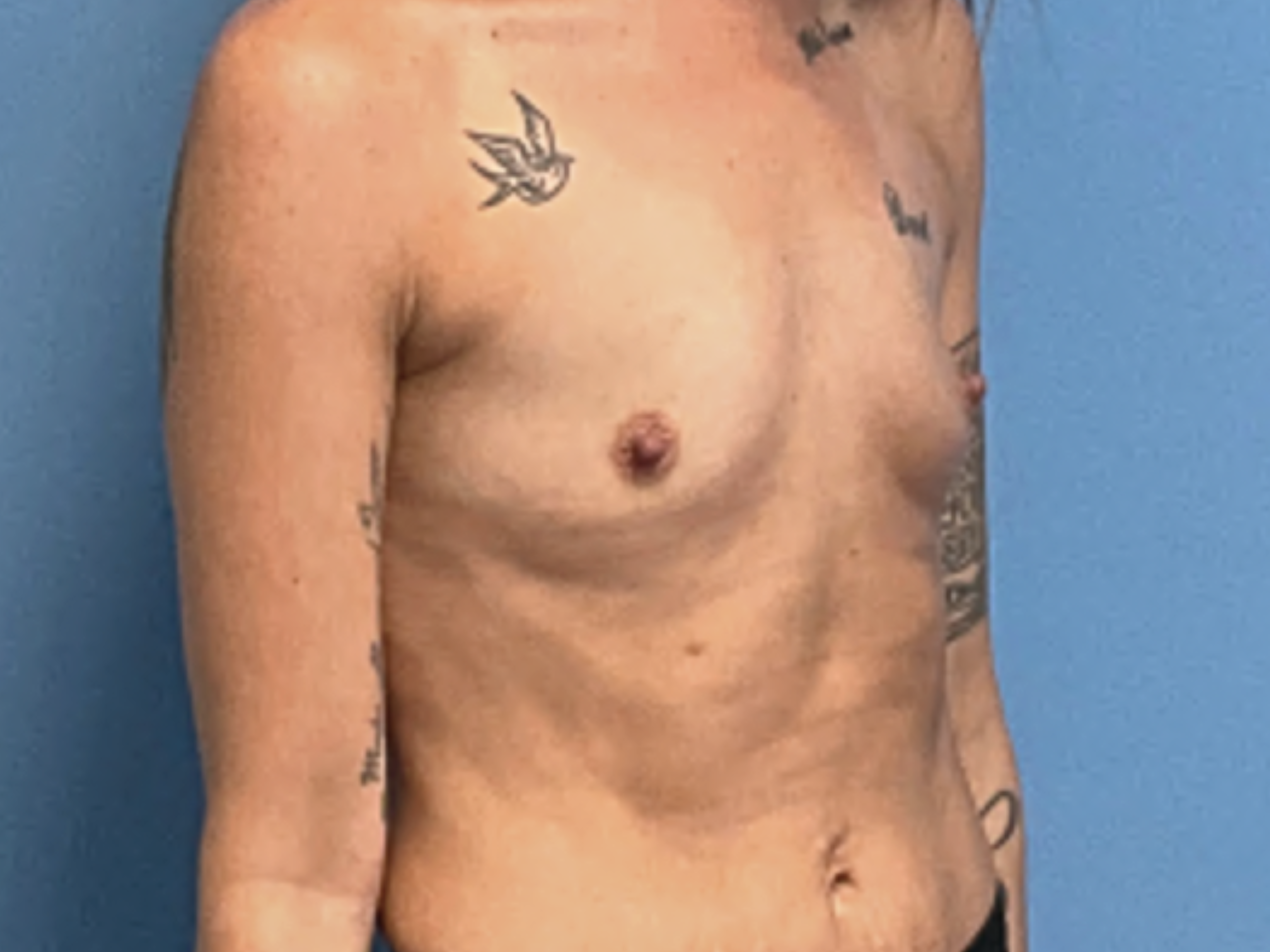 Breast-Augmentation--Case-Study-6928 | Before Breast Augmentation