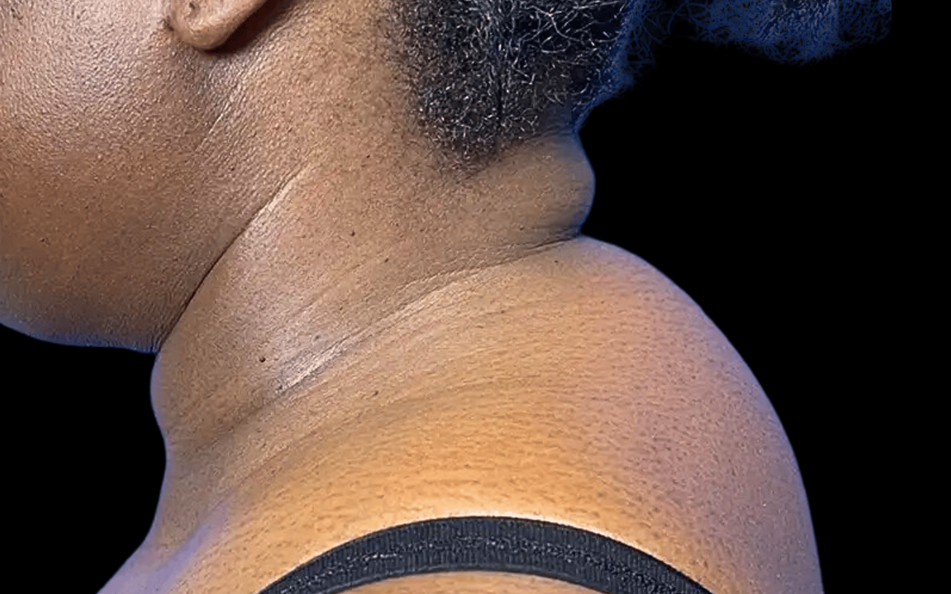 BodyTite--Case-Study-9057 | Before BodyTite