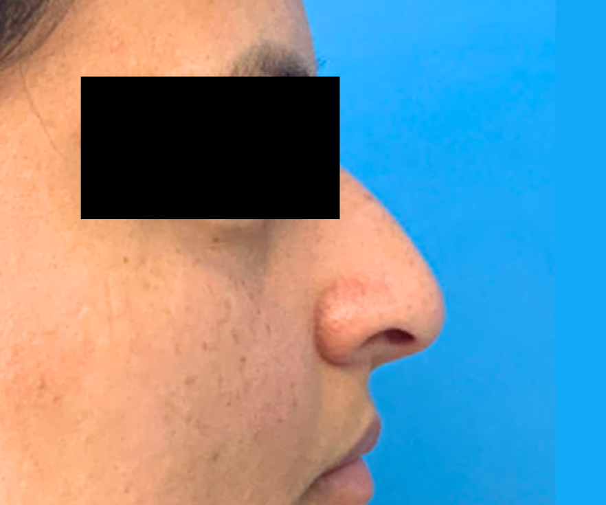 RHINOPLASTY--Case-Study-9427 | Before Rhinoplasty